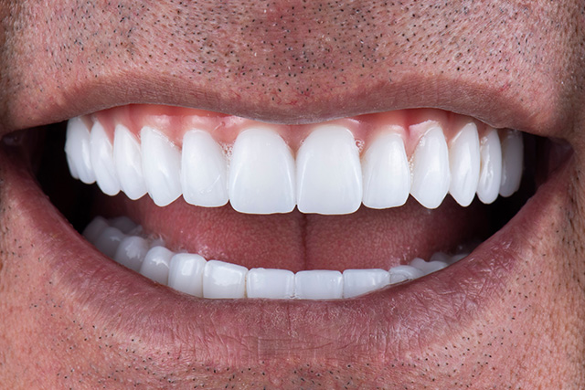 a picture of a patient after getting dental implants