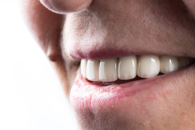 an after treatment image of a patient with a full set of teeth post his dental implants procedure
