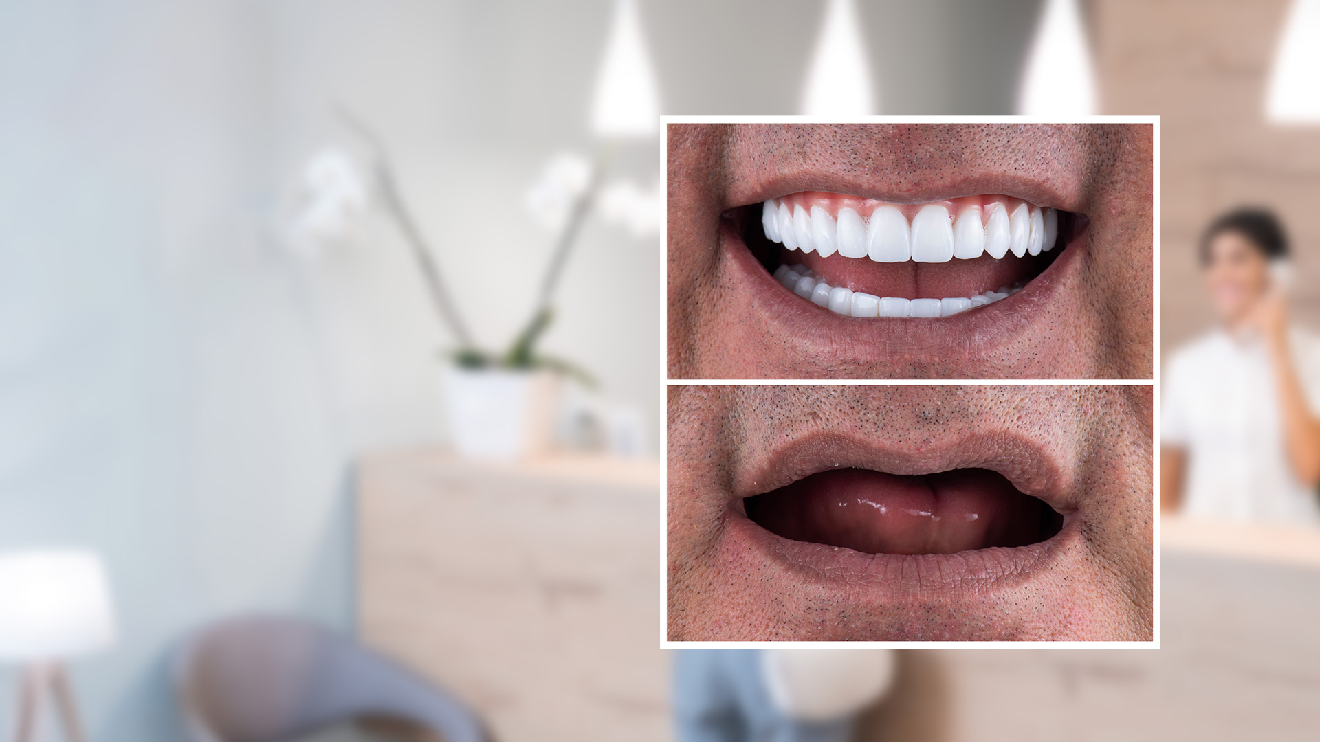 a before and after image of a patient after getting all on 4 dental implants