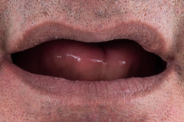 a picture of a patient before getting dental implants
