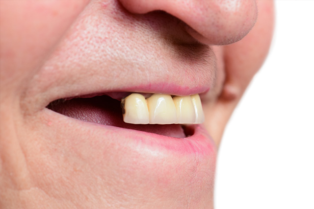 a before treatment image of a patient missing teeth
