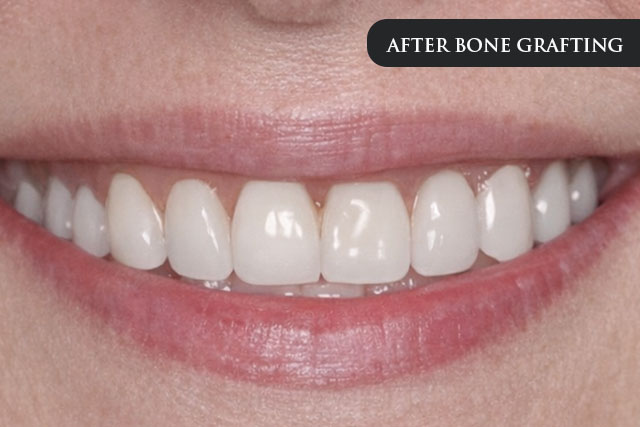 an after treatment image of a patient after bone grafting procedure