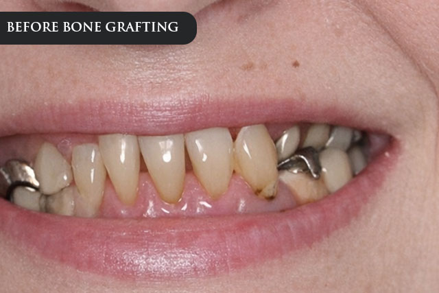 a before treatment image of a patient with receding gumline and bad teeth