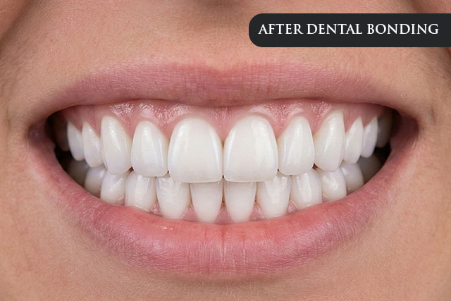 an after treatment image of a patient post her dental bonding procedure