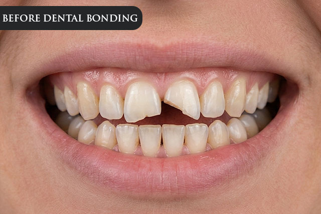 a before treatment image of a patient with a chipped tooth