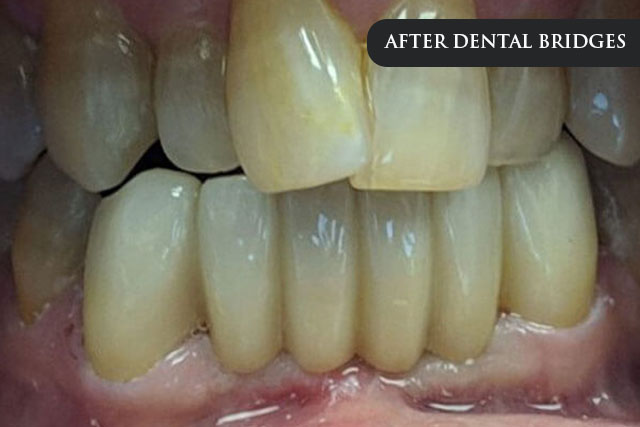 an after treatment image of a patient after getting dental bridges