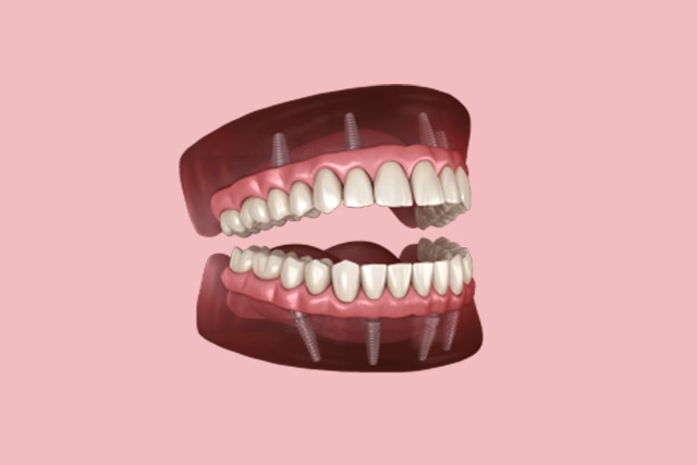 false teeth dentures for upper and lower jaw with 8 implants in total