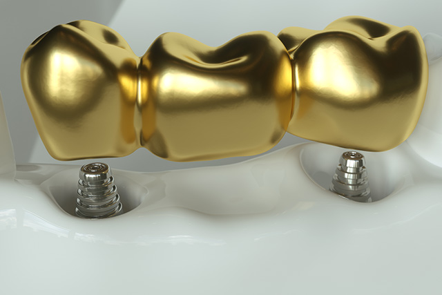 dental implants near me