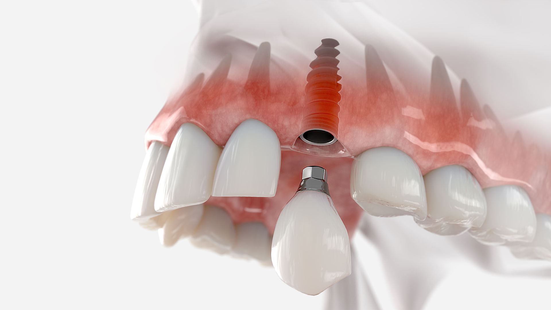 a dental implant placed on jawline