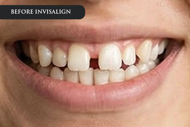 a before treatment image of a patient with uneven teeth and gaps