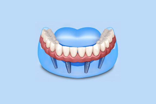 full mouth implants from our dentist near riverbank ca