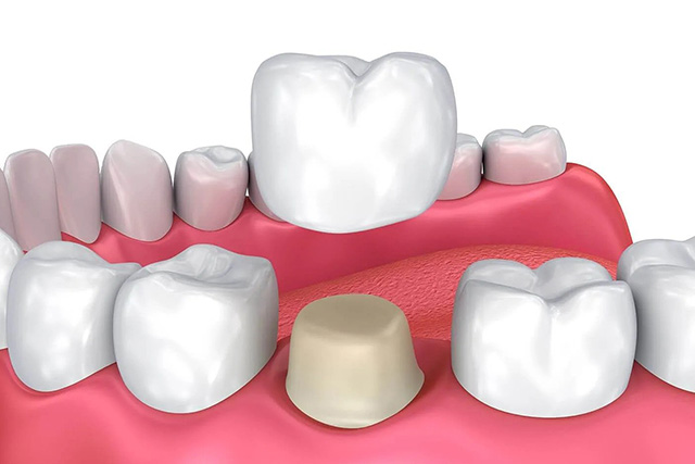 dental crown from our dentist near riverbank ca