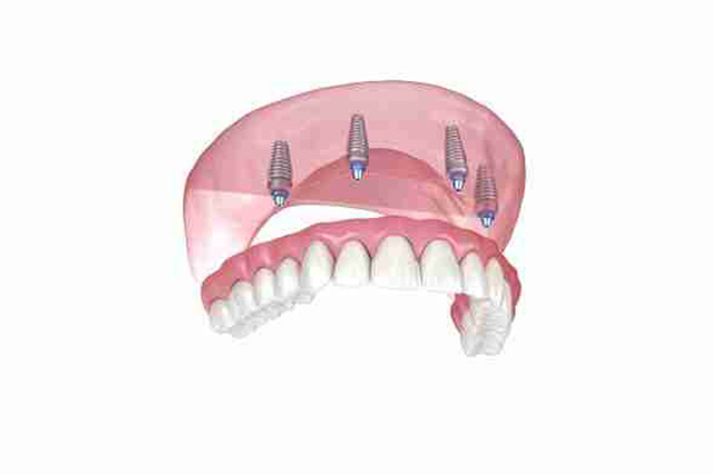 dental implants near me