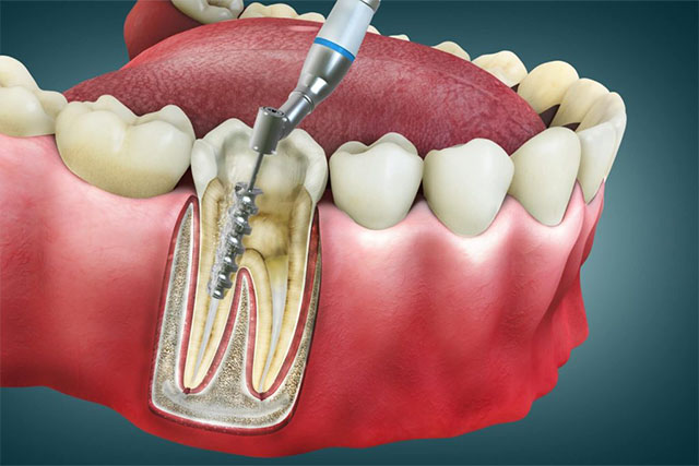 root canal from our dentist near riverbank ca