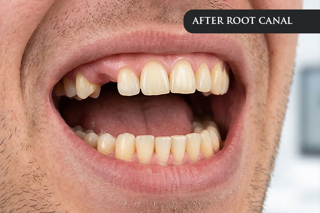 an after treatment image of a patient after root canal therapy procedure