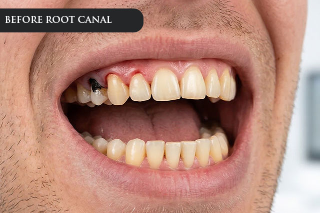 a before treatment image of a patient with infected teeth