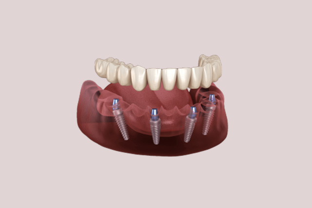 false teeth dentures with 4 implants