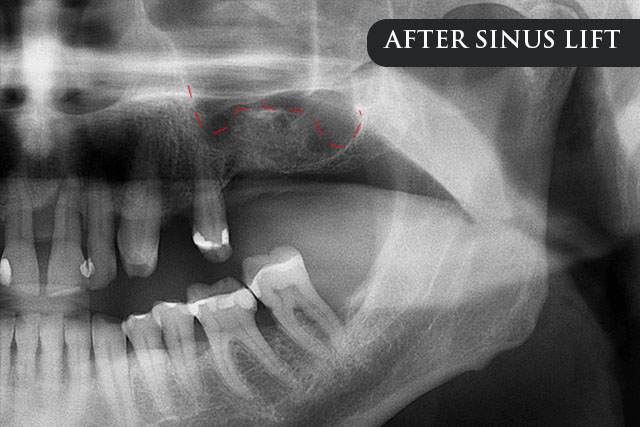 an after treatment 3D renderings showing the maxillary sinus membrane being lifted and bone graft material being added