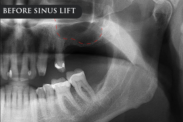 a before treatment 3D renderings showing the maxillary sinus membrane