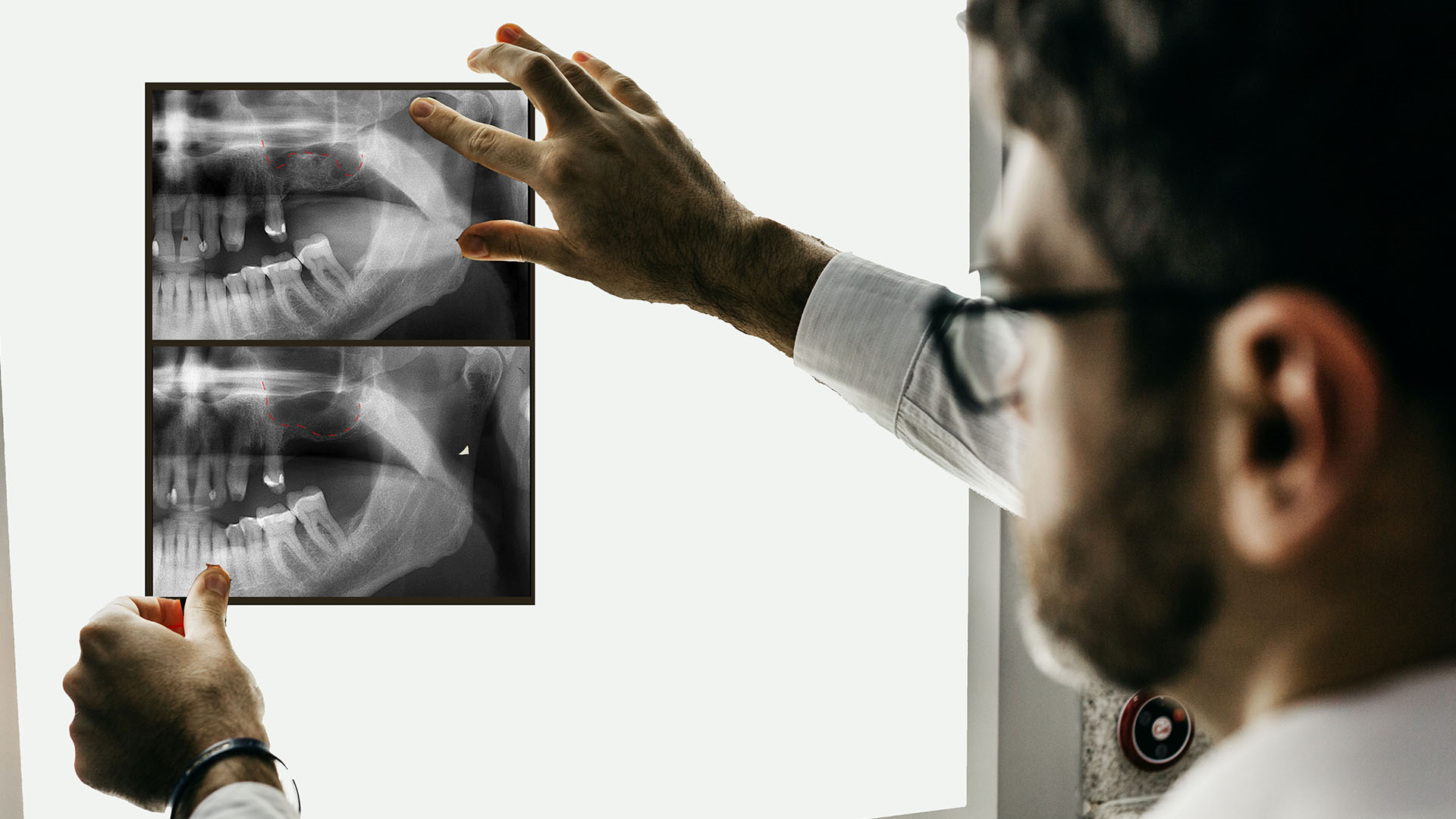 a dentist viewing 3D renderings showing the maxillary sinus membrane being lifted and bone graft material being added