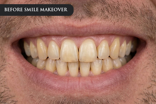 a before treatment image of a patient with discolored teeth