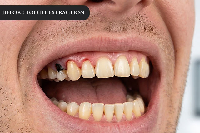 a before treatment image of a patient with infected teeth