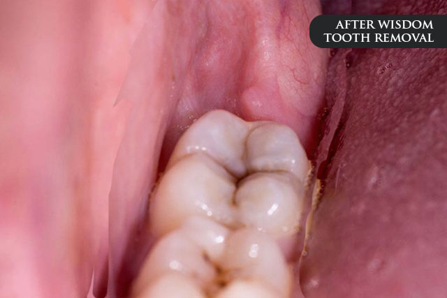 an after treatment image of a patient after wisdom tooth extraction