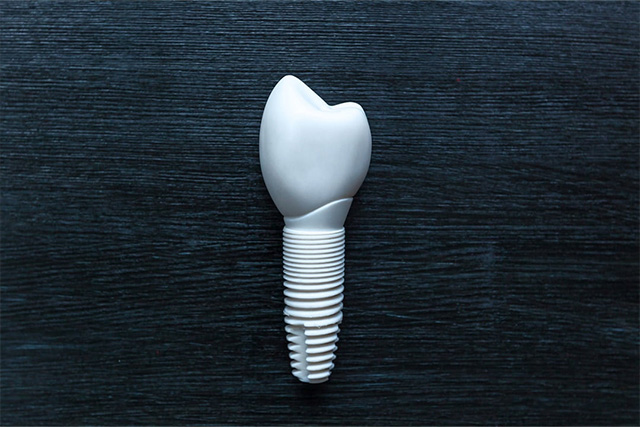 dental implants near me
